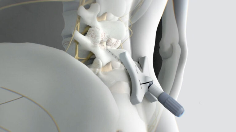 Mild Device Interventional Pain Management Center - Oklahoma Heart Hospital