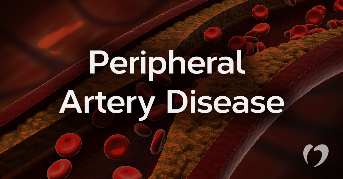 Peripheral Artery Disease: Symptoms and Treatments